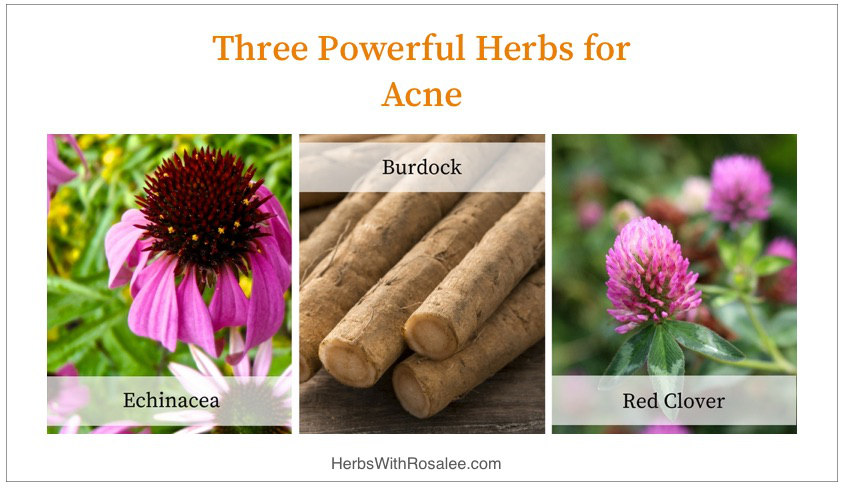 natural remedies for acne